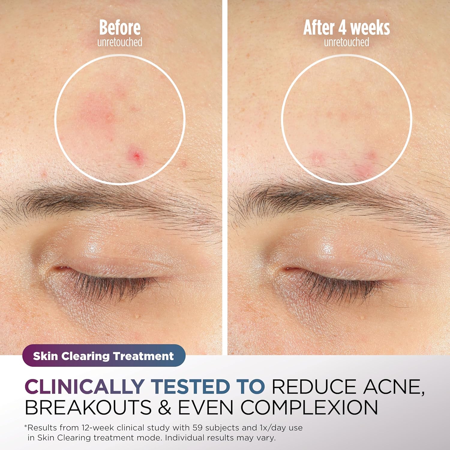 Cryoglow LED Face Mask – Anti-Aging & Blemish Repair